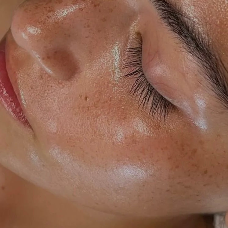 RF MICRONEEDLING WITH EXOSOMES FACE (inc jaw)