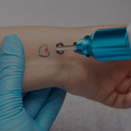 TATTOO REMOVAL